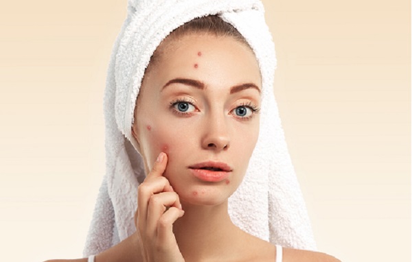 The Right Acne Treatment for You